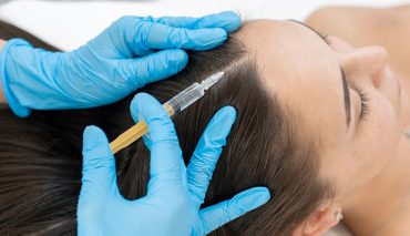 Find Out More About The Price Of The Best Hair Loss Treatment In Singapore Here